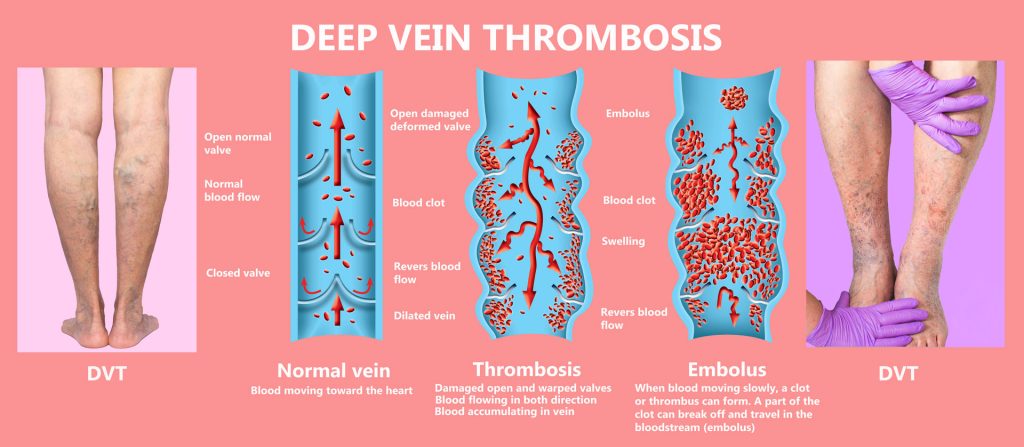 Diagram indicating deep Vein Thrombosis or Blood Clots. Embolus.