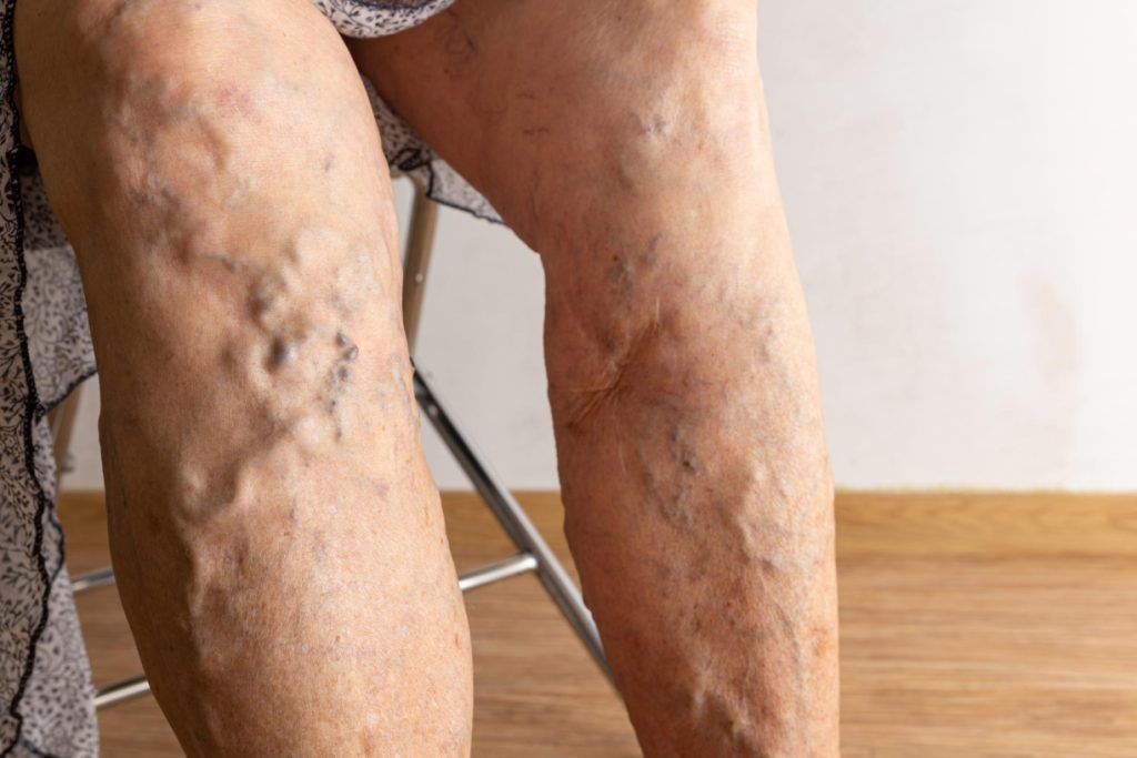 An elder woman's bare legs with exposed spider and varicose swollen veins