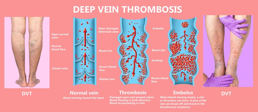 Deep Vein Thrombosis DVT 257290871 1024x447