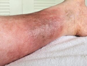 Swolen Leg Suffering from Venous Insuficiency 422338390 1024x774