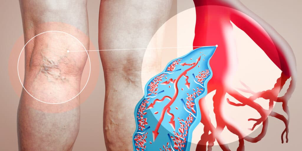 Varicose Veins On Person Clogged Amplified 448055100