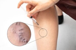 Sclerotherapy Magnified View of Vein 295448317 1024x683